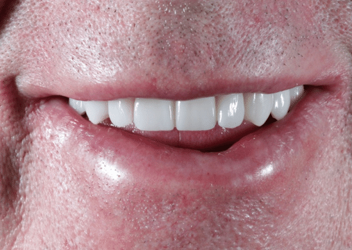 After - Burgate Dental Practice & Implant Centre