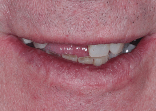 Before - Burgate Dental Practice & Implant Centre