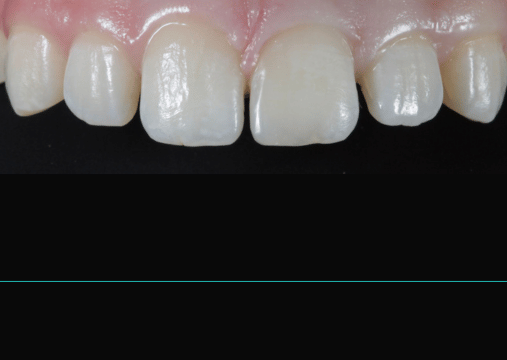 After - Burgate Dental Practice & Implant Centre