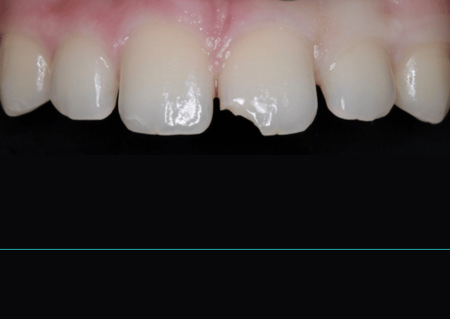 Before - Burgate Dental Practice & Implant Centre