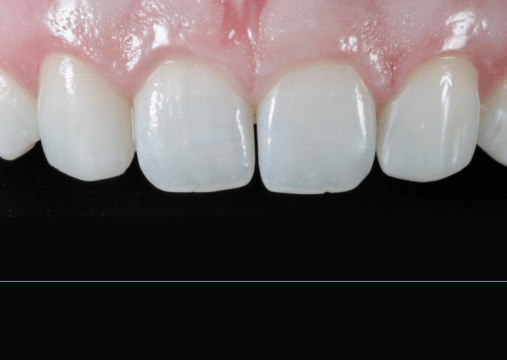 After - Burgate Dental Practice & Implant Centre