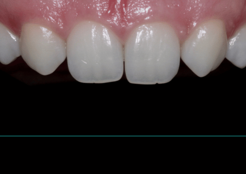 Before - Burgate Dental Practice & Implant Centre