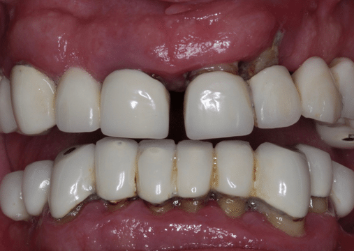 Before - Burgate Dental Practice & Implant Centre