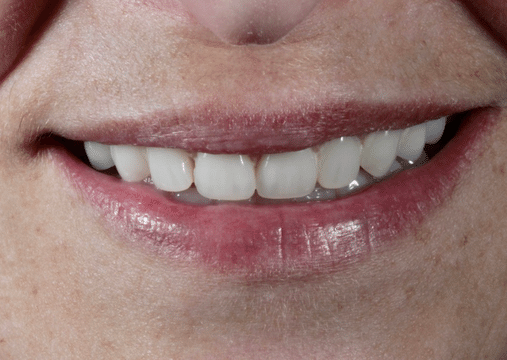 After - Burgate Dental Practice & Implant Centre