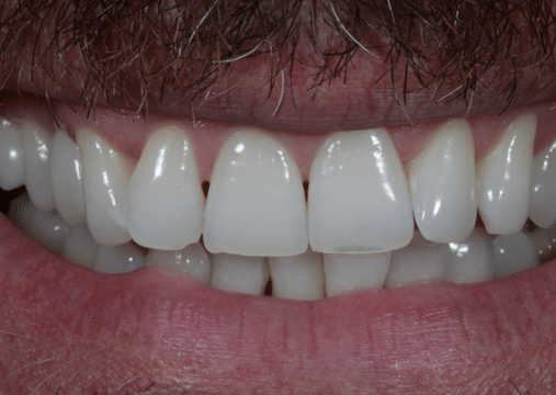 After - Burgate Dental Practice & Implant Centre