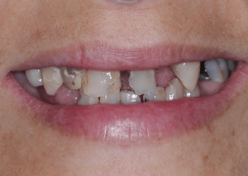 Before - Burgate Dental Practice & Implant Centre