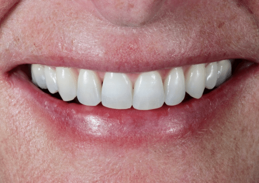 After - Burgate Dental Practice & Implant Centre