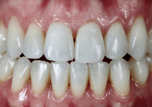 After - Burgate Dental Practice & Implant Centre