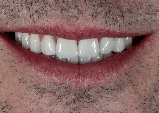 After - Burgate Dental Practice & Implant Centre