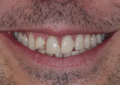 Before - Burgate Dental Practice & Implant Centre