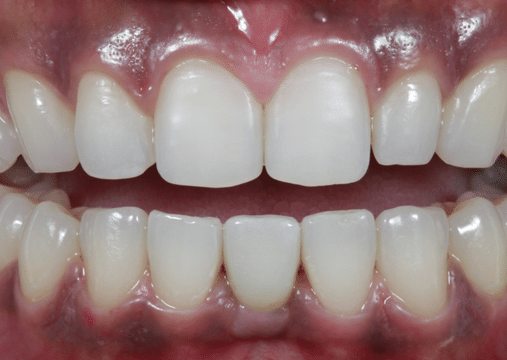 After - Burgate Dental Practice & Implant Centre