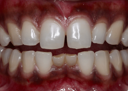 Before - Burgate Dental Practice & Implant Centre