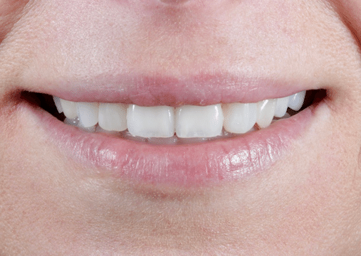 After - Burgate Dental Practice & Implant Centre