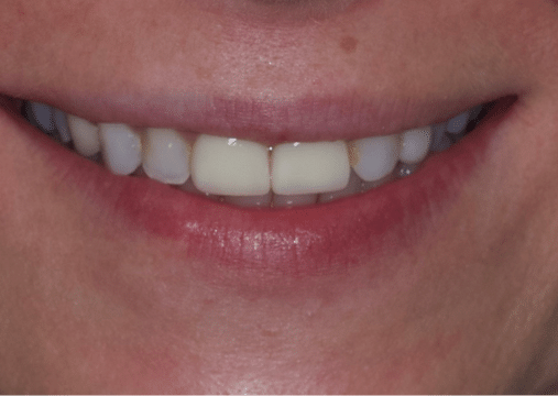 Before - Burgate Dental Practice & Implant Centre