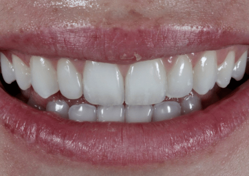 After - Burgate Dental Practice & Implant Centre