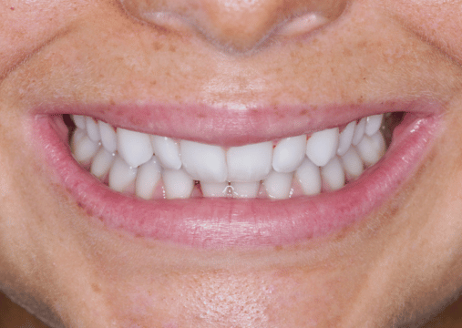 Before - Burgate Dental Practice & Implant Centre