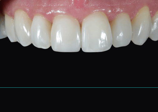 After - Burgate Dental Practice & Implant Centre