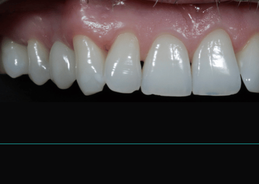 After - Burgate Dental Practice & Implant Centre