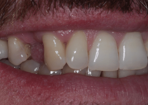 Before - Burgate Dental Practice & Implant Centre