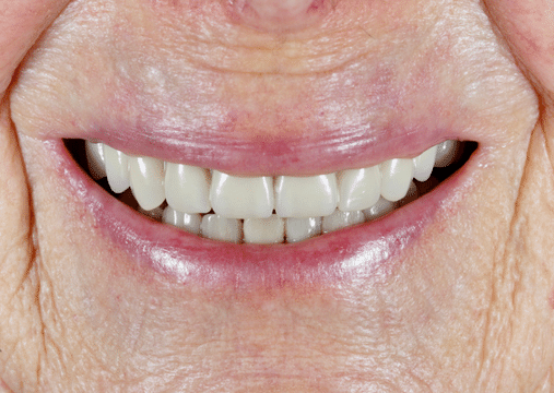 After - Burgate Dental Practice & Implant Centre