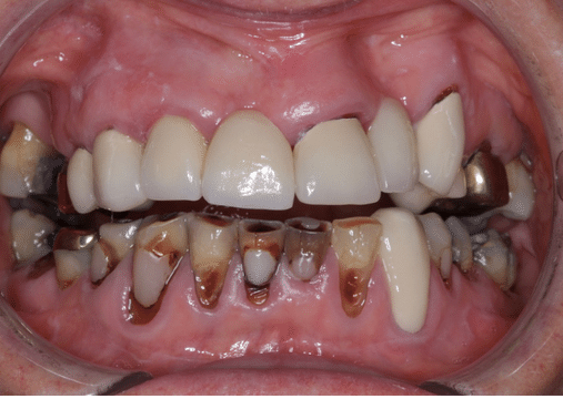 Before - Burgate Dental Practice & Implant Centre