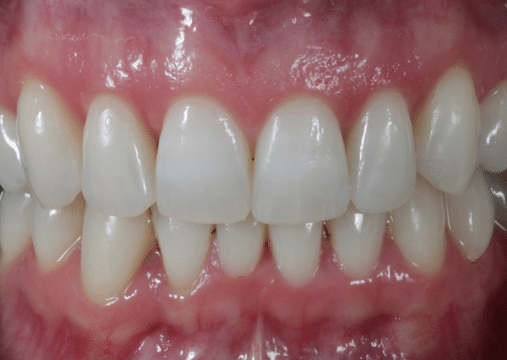 After - Burgate Dental Practice & Implant Centre