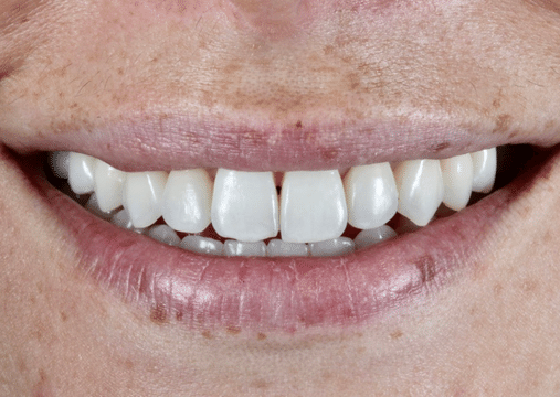 After - Burgate Dental Practice & Implant Centre