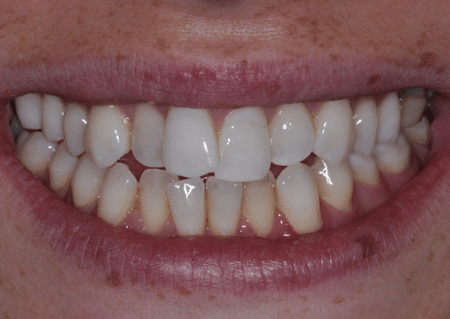 Before - Burgate Dental Practice & Implant Centre