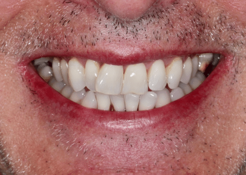 Before - Burgate Dental Practice & Implant Centre