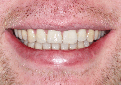 After - Burgate Dental Practice & Implant Centre