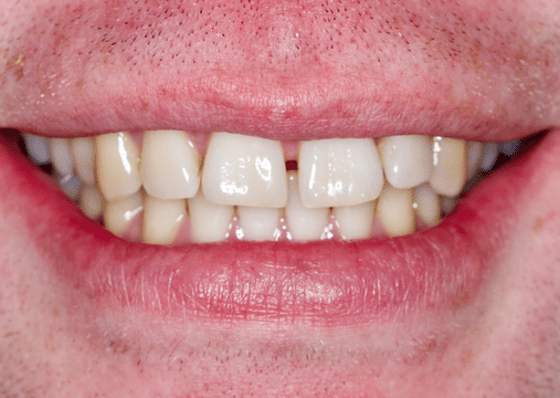 Before - Burgate Dental Practice & Implant Centre