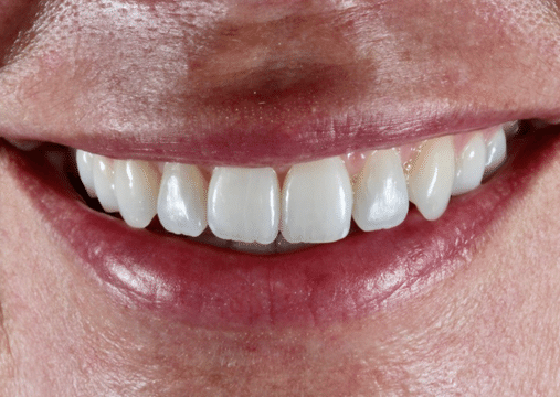 After - Burgate Dental Practice & Implant Centre