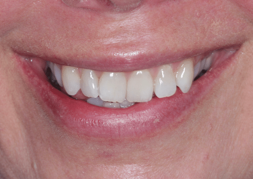 Before - Burgate Dental Practice & Implant Centre