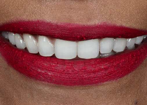 After - Burgate Dental Practice & Implant Centre