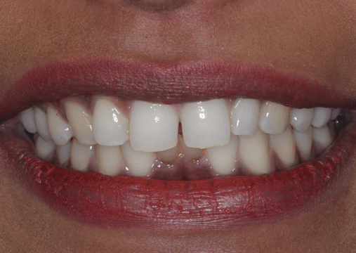 Before - Burgate Dental Practice & Implant Centre