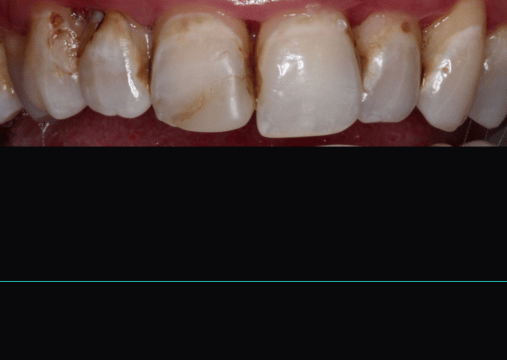 Before - Burgate Dental Practice & Implant Centre