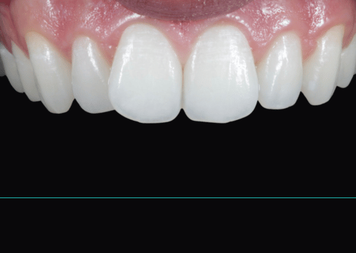 After - Burgate Dental Practice & Implant Centre