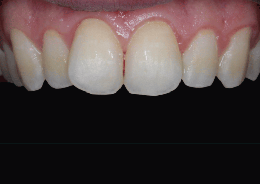 Before - Burgate Dental Practice & Implant Centre