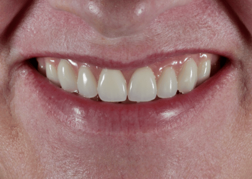 After - Burgate Dental Practice & Implant Centre