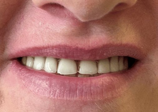 Before - Burgate Dental Practice & Implant Centre