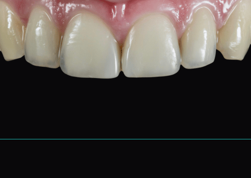 After - Burgate Dental Practice & Implant Centre