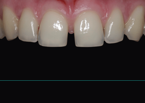 Before - Burgate Dental Practice & Implant Centre