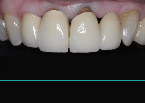 Before - Burgate Dental Practice & Implant Centre