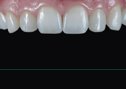 After - Burgate Dental Practice & Implant Centre