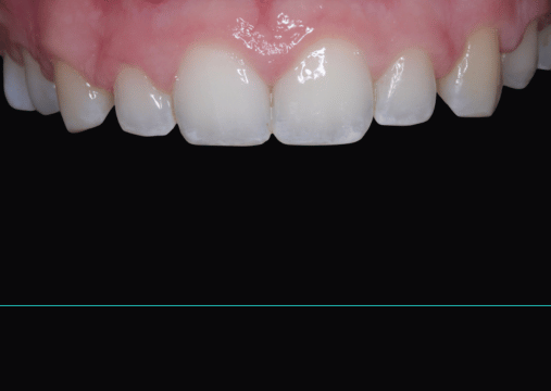 Before - Burgate Dental Practice & Implant Centre