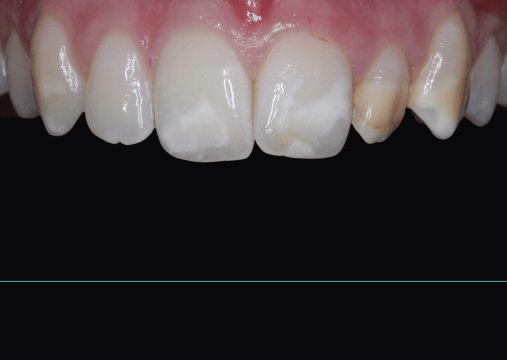 Before - Burgate Dental Practice & Implant Centre