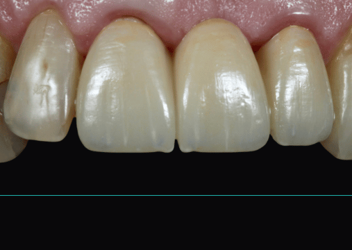 After - Burgate Dental Practice & Implant Centre