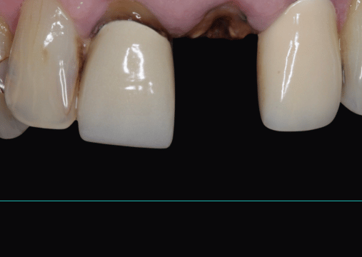 Before - Burgate Dental Practice & Implant Centre