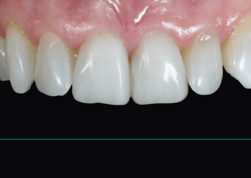 After - Burgate Dental Practice & Implant Centre