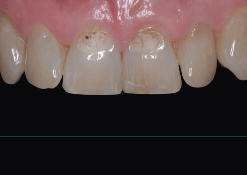 Before - Burgate Dental Practice & Implant Centre